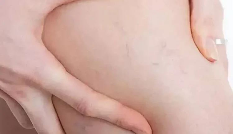 Kronik Venöz Yetmezlik Nedir?