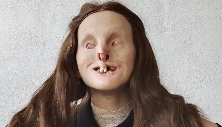 Rabia Yeralmaz Kimdir, Hastalığı Ne, Neden Öyle?