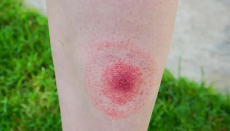 Lyme Disease, Hastalığı Nedir?