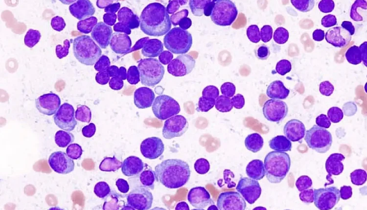 Multiple Myeloma Nedir?